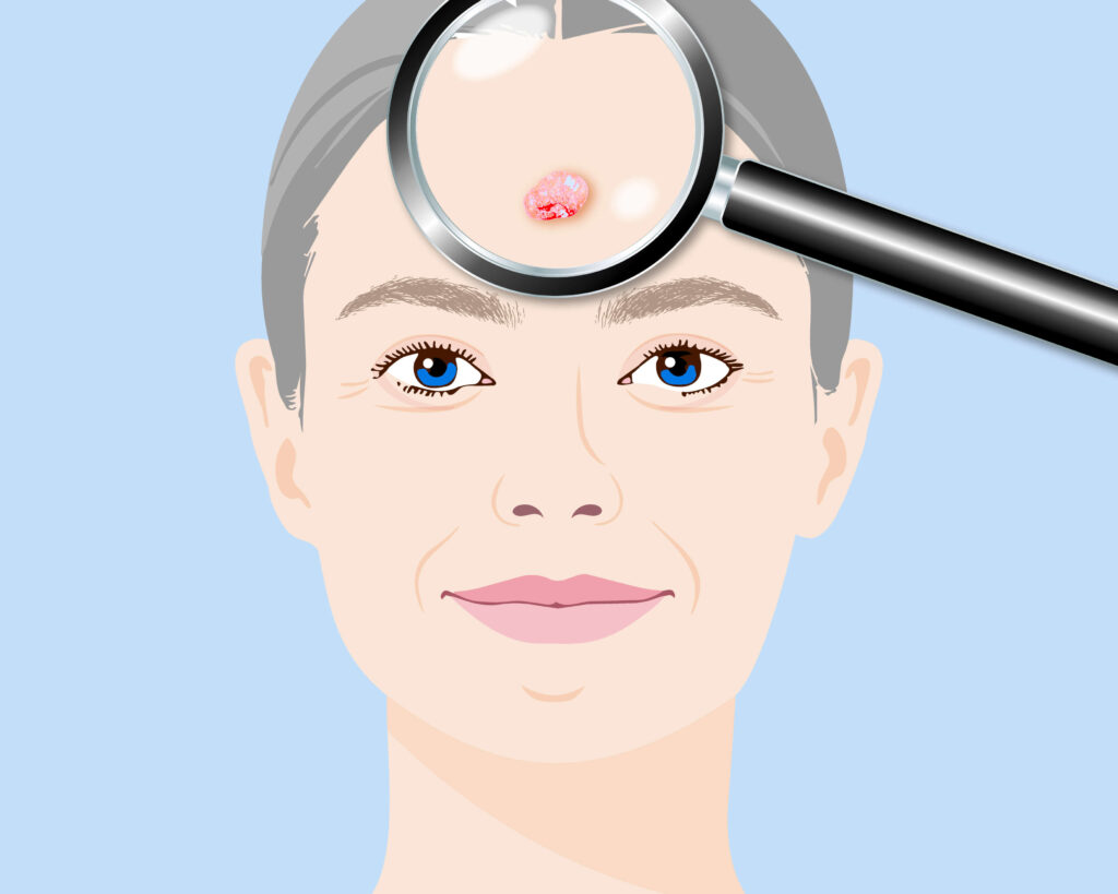 Hautkrebsdiagnose